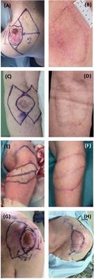 The Use of Keystone Flaps in Periarticular Wound Closure: A Case Series